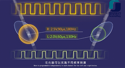 Bilateral Different Frequency Stimulation